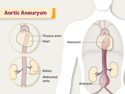 Aortic aneurysms